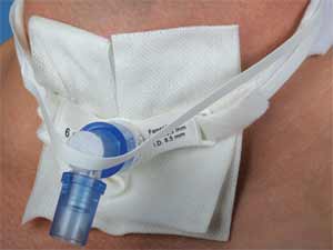 Tracheostomy Vent Tie, Anti-Disconnect-104PPZMD