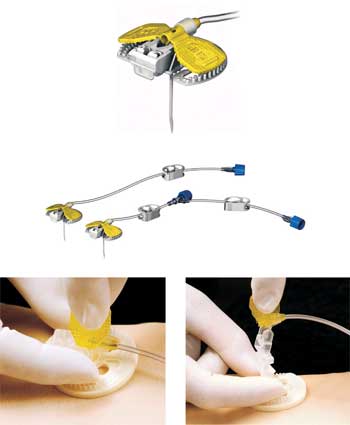 Huber LiftLoc Safety Wing Infusion Set 19 Gauge x 1 in. Long 8 in. Tubing-0191010SIHSMD