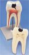 2 Part Lower Twin-Root Molar Tooth w/ Cavities