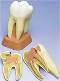 2 Part Upper Triple-Root Molar w/ Cavities