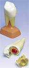 2 Part Upper Twin-Root Molar w/ Cavities Anatomical Model