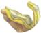 Image Showing Boutonneiere and Swan Neck Deformity