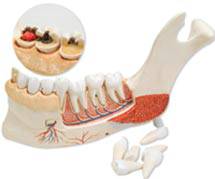 Advanced Half Lower Jaw Diseased Teeth Model