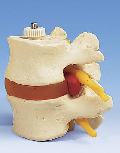 2 Lumbar Vertebrae w/ Prolapsed Disc Mod