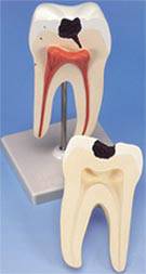 Lower Twin-Root Molars Tooth w/ Cavities