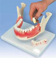 Dental Disease Anatomy Model
