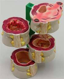 4-Piece Colon Model Pathologies