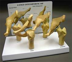 4-Stage Arthritis Hip Model