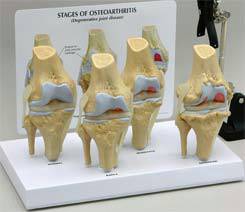 4-Stage Osteoarthritic Knee