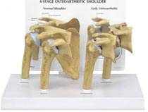 4-Stage Osteoarthritis Shoulder Model