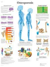 Professional Osteoporosis Chart