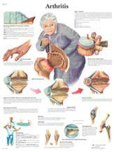 Professional Arthritis Chart