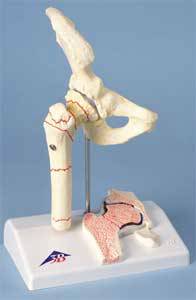 Anatomical Femoral Fracture and Hip Oste
