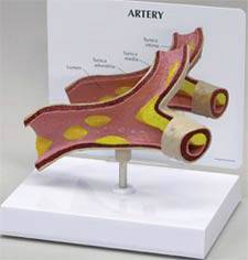 Artery Model Plaque