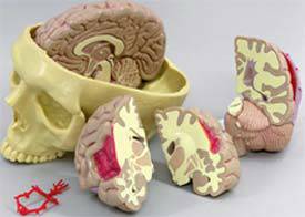 Brain Model - Half Normal  Half Pathology