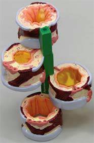 Bronchus Model Showing Asthma & Bronchitis