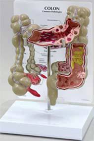 Colon Model w/ Pathologies