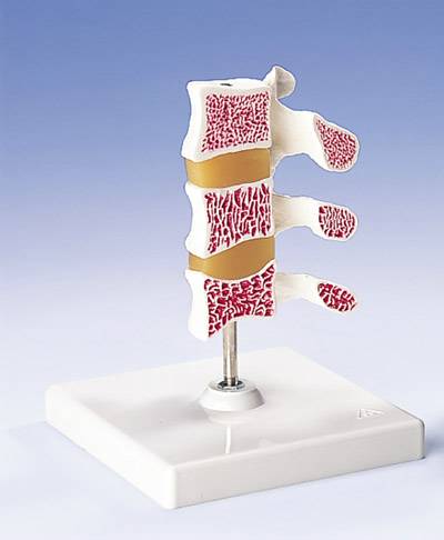 Deluxe 3 Vertebrae Osteoporosis Model