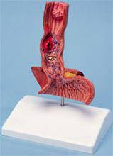 Diseases of the Esophagus Anatomical Model