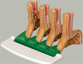 Gastroesophageal Reflux Disease Model