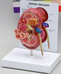 Kidney Cancer Model