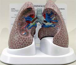 Lung Cancer Model