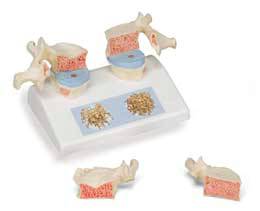 Osteoporosis Model