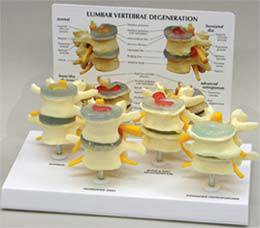 4-Stage Osteoporosis Vertebrae Model