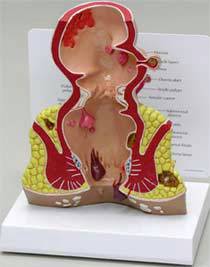 Rectum Model Pathologies