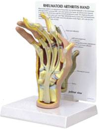 Rheumatoid Arthritis Hand Model