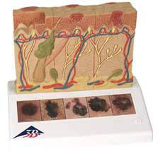 Skin Cancer Model