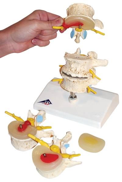 Stages of Vertebral Degeneration Model