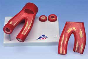 Arteriosclerosis w/ Cross Section of Artery Model