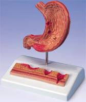 Stomach Anatomy Model with Ulcers