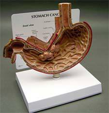 Stomach Cancer Model