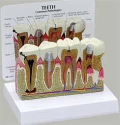 Teeth Pathologies Dental Model